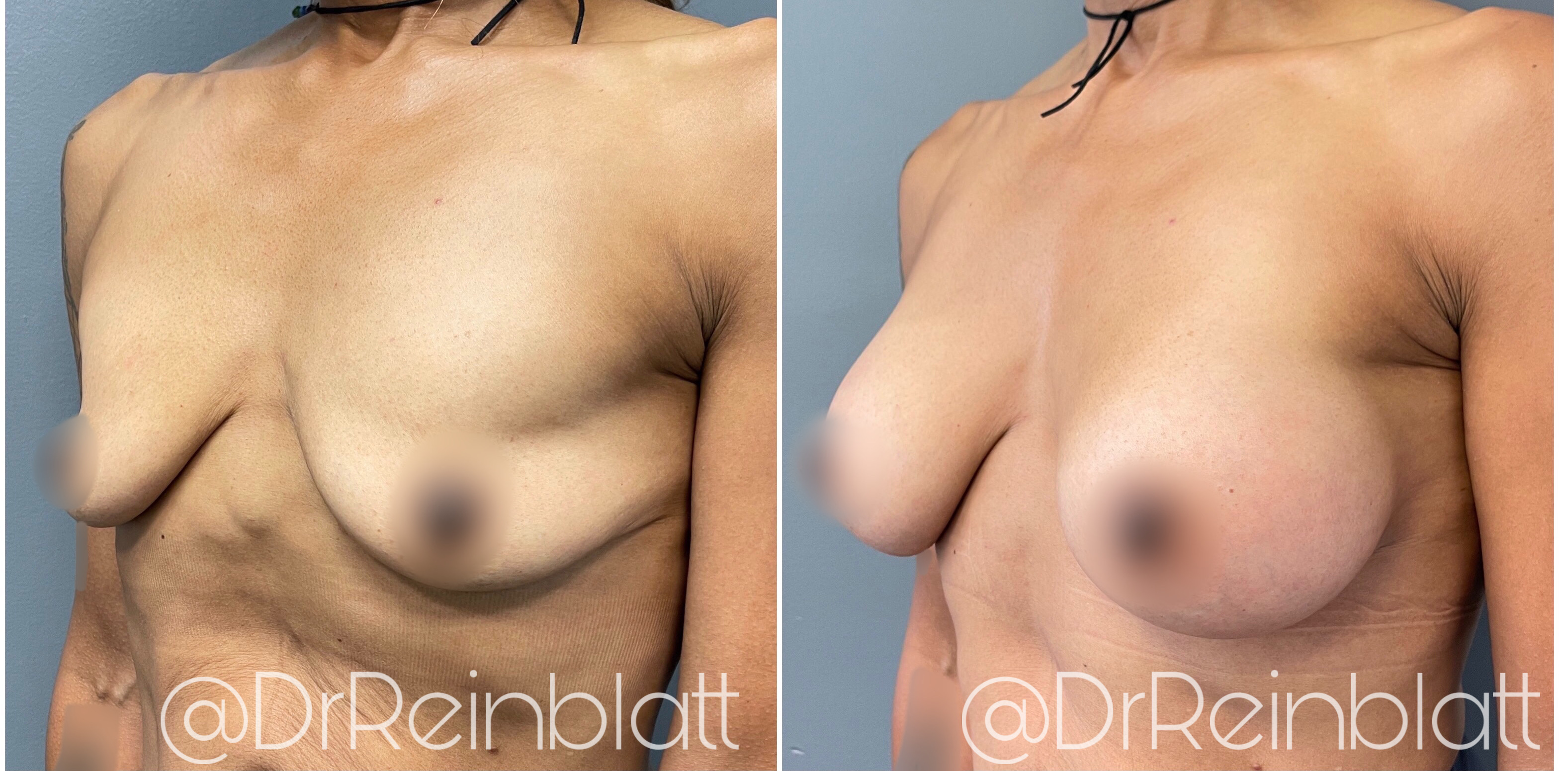 Breast Augmentation Before and After | Dr. Maura Reinblatt