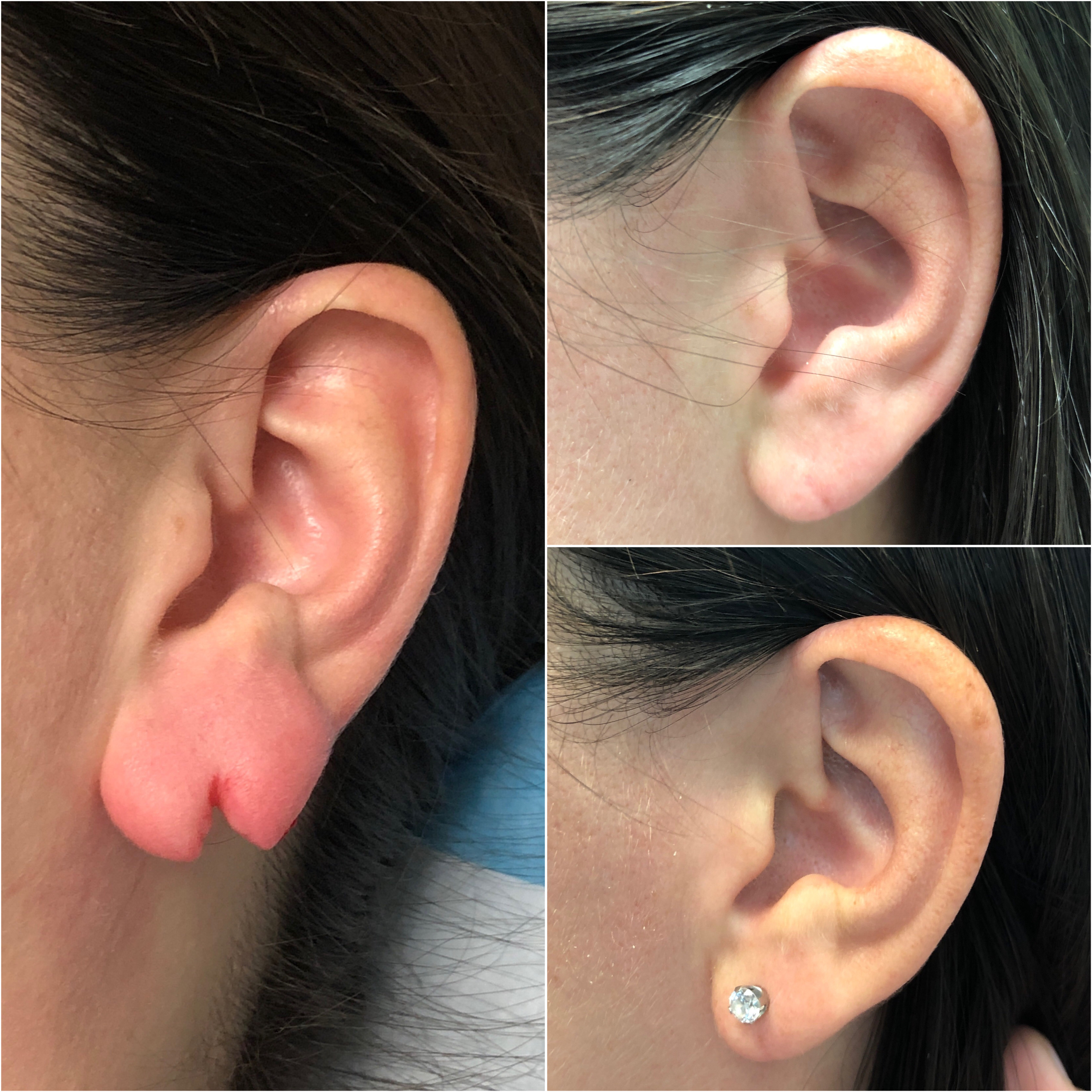Torn and stretched ear lobe repairs - Kingsley Medical