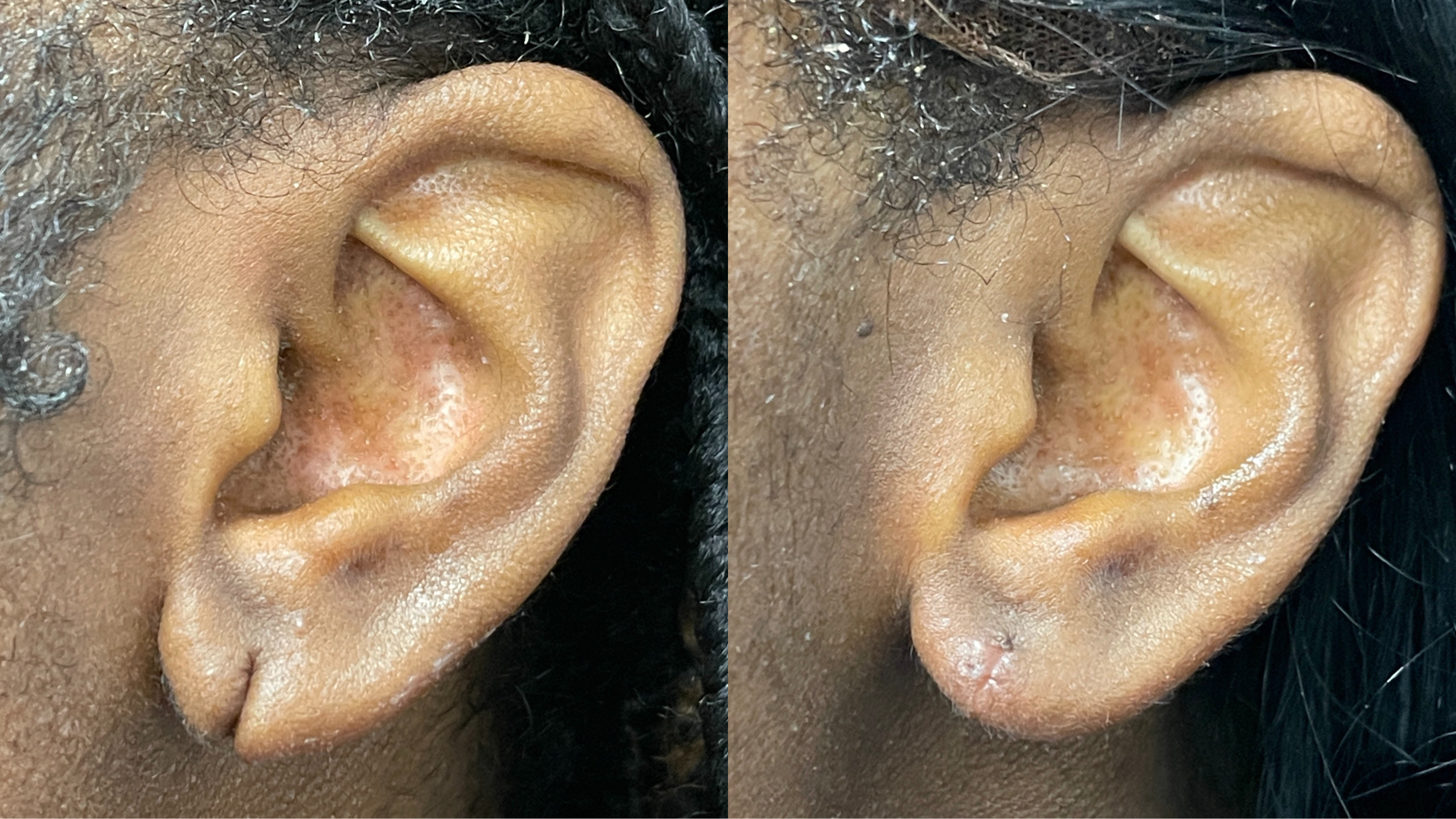 Ear Lobe Repair in Westchester NY
